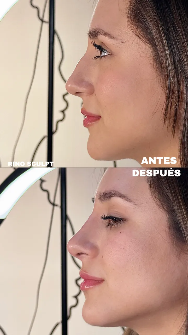 Resultado Rinosculpt — perfil